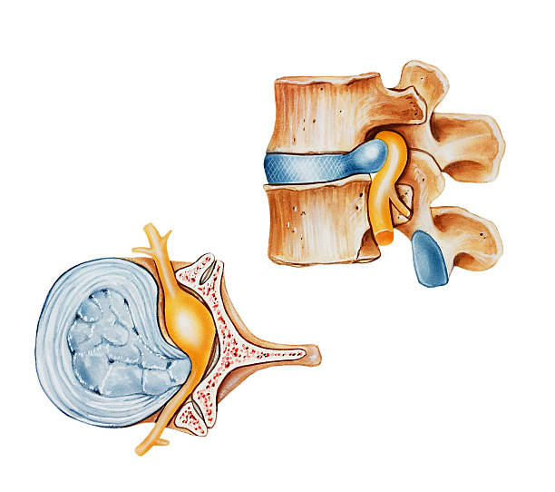 hernia discal