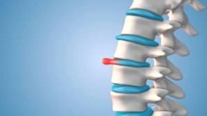Hernia Discal Lumbar